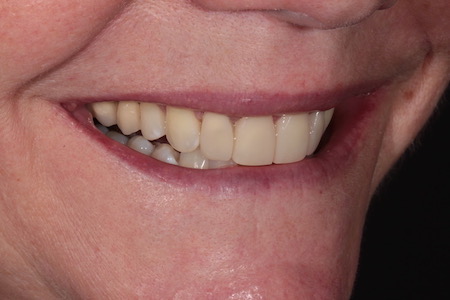 Before and After Invisalign Treatment Windsor Before and After Invisalign Treatment Windsor