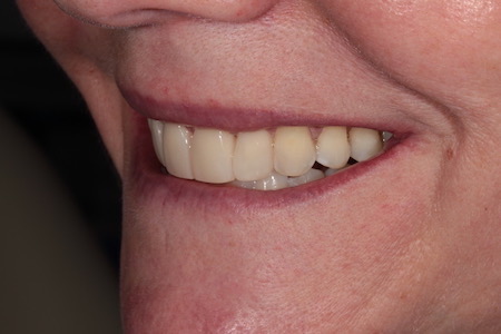 Before and After Invisalign Treatment Windsor Before and After Invisalign Treatment Windsor