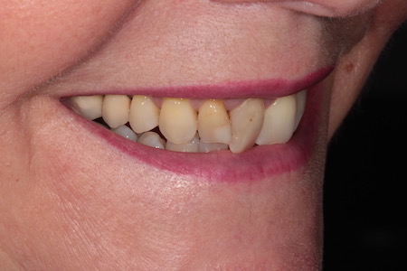 Before and After Invisalign Treatment Windsor Before and After Invisalign Treatment Windsor