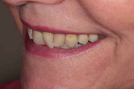 Before and After Invisalign Treatment Windsor Before and After Invisalign Treatment Windsor