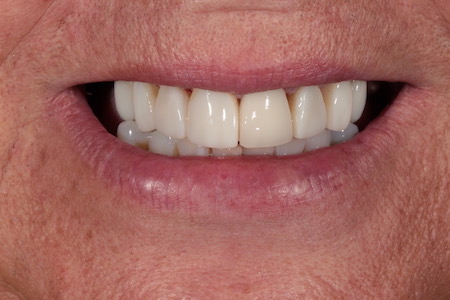 Before and After Invisalign Treatment Windsor Before and After Invisalign Treatment Windsor