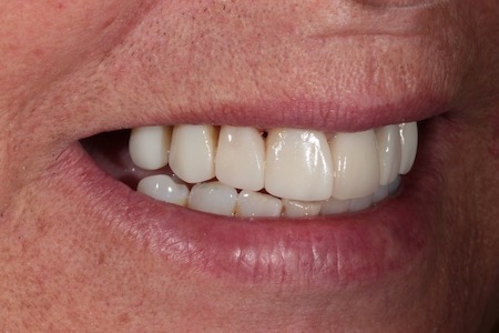 Before and After Invisalign Treatment Windsor Before and After Invisalign Treatment Windsor