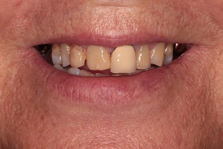 Before and After Invisalign Treatment Windsor Before and After Invisalign Treatment Windsor