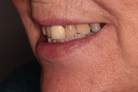Before and After Invisalign Treatment Windsor Before and After Invisalign Treatment Windsor