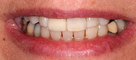 Before and After Invisalign Treatment Windsor Before and After Invisalign Treatment Windsor