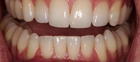 After Invisalign Treatment Reading Smiles