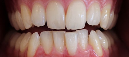 Before Invisalign Treatment Reading Smiles