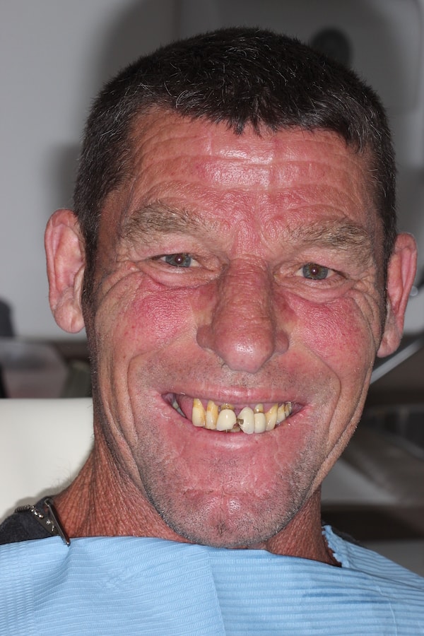 Before and After Implants Treatment Windsor