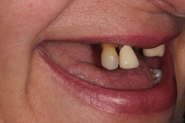 Before and After Implants Treatment Windsor