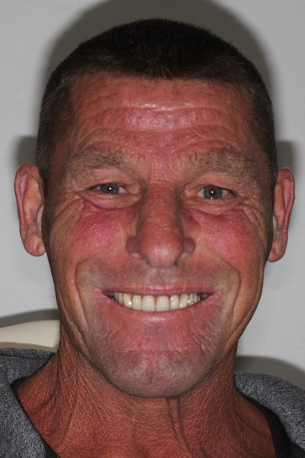 Before and After Implants Treatment Windsor