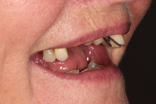 Before and After Implants Treatment Windsor