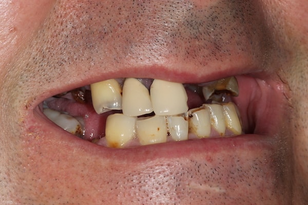 Before and After Implants Treatment Windsor