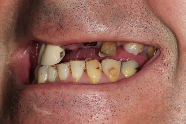 Before and After Implants Treatment Windsor