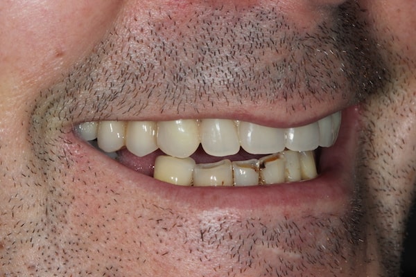 Before and After Implants Treatment Windsor