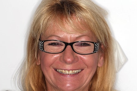 Before and After Invisalign Treatment Windsor Before and After Invisalign Treatment Windsor