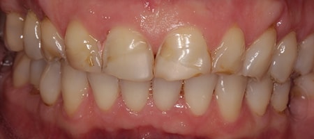 Before and After Invisalign Treatment Windsor Before and After Invisalign Treatment Windsor