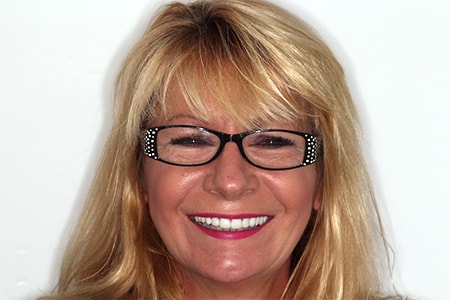 Before and After Invisalign Treatment Windsor Before and After Invisalign Treatment Windsor