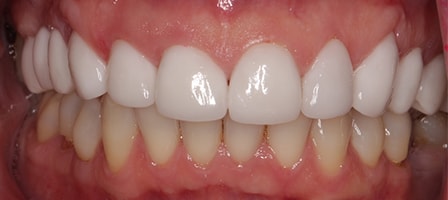 Before and After Invisalign Treatment Windsor Before and After Invisalign Treatment Windsor
