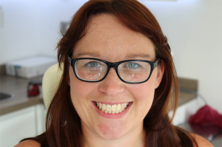 Before Invisalign Treatment Reading Smiles