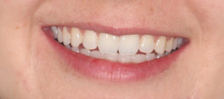 After Invisalign Treatment Reading Smiles