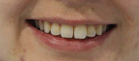 Before Invisalign Treatment Reading Smiles