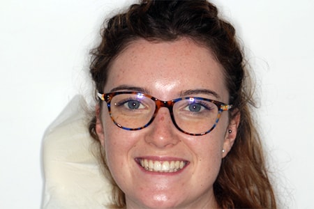 After Invisalign Treatment Reading Smiles