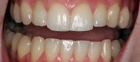 After Invisalign Treatment Reading Smiles