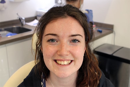 Before Invisalign Treatment Reading Smiles