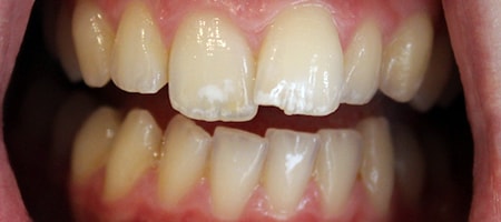 Before Invisalign Treatment Reading Smiles