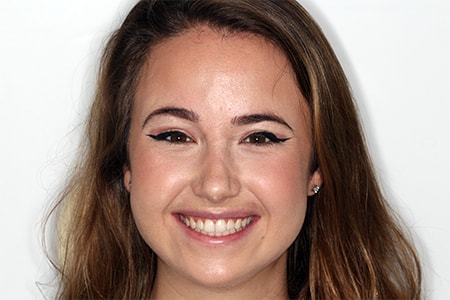 After Invisalign Treatment Reading Smiles