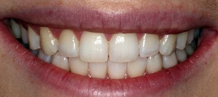 After Invisalign Treatment Reading Smiles