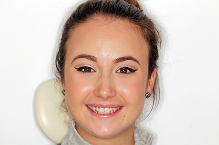 Before Invisalign Treatment Reading Smiles