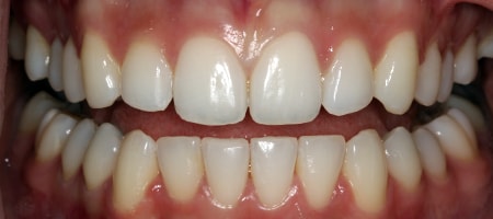 After Invisalign Treatment Reading Smiles
