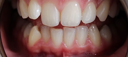 Before Invisalign Treatment Reading Smiles