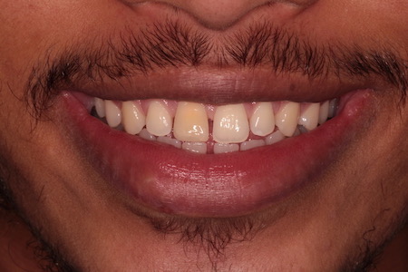 Before and After Invisalign Treatment Windsor Before and After Invisalign Treatment Windsor