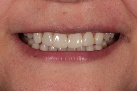 Before and After Invisalign Treatment Windsor Before and After Invisalign Treatment Windsor