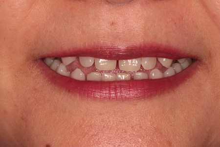 Before and After Invisalign Treatment Windsor Before and After Invisalign Treatment Windsor