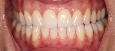After Invisalign Treatment Reading Smiles