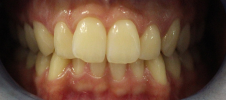 Before Invisalign Treatment Reading Smiles