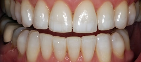 After Invisalign Treatment Reading Smiles
