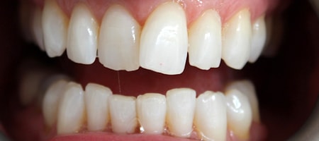 Before Invisalign Treatment Reading Smiles