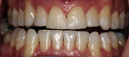 After Invisalign Treatment Reading Smiles