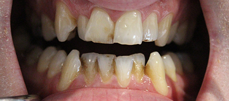 Before Invisalign Treatment Reading Smiles