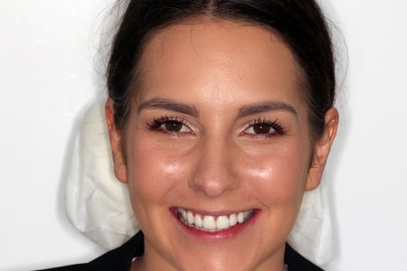 After Invisalign Treatment Reading Smiles