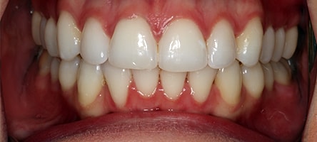 After Invisalign Treatment Reading Smiles