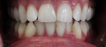 Before Invisalign Treatment Reading Smiles