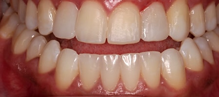 After Invisalign Treatment Reading Smiles