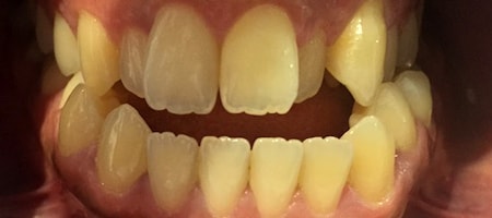 Before Invisalign Treatment Reading Smiles