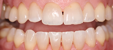 After Invisalign Treatment Reading Smiles