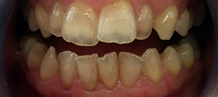 Before Invisalign Treatment Reading Smiles